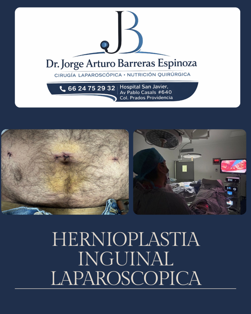 hernioplastia inguinal laparoscopica